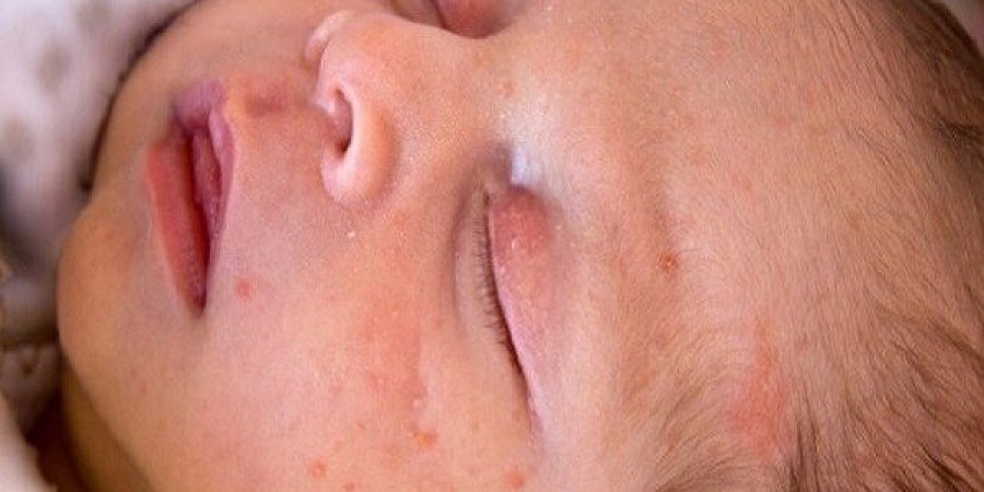 فنیل‌کتونوری یا Phenylketonuria (PKU)
